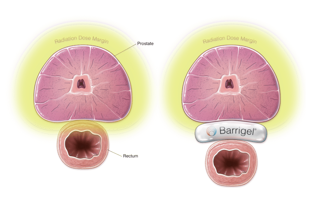 Axial view of pelvic anatomy before and after Barrigel rectal spacer placement for prostate cancer radiotherapy.