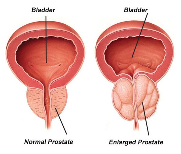 diagram showing benign prostate enlargement (BPH), compressing on urethra