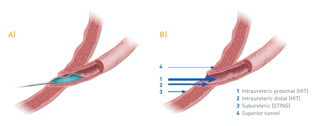 Diagram showing Deflux injection for vesicoureteral reflux (VUR), with gel placed near the ureteral opening to prevent urine from flowing back into the kidneys.
