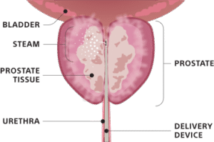 Rezum water vapour therapy for benign prostate enlargement (BPH) available in Prince Court Medical Centre Kuala Lumpur with consultant urologist Dr. Roger