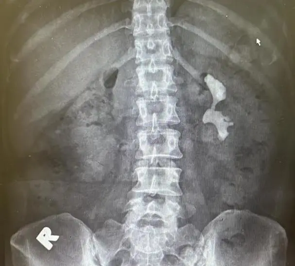X-ray Kidney, Ureter and Bladder (KUB) showing staghorn calculi, kidney stone