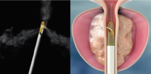 Rezum device delivering steam into prostate tissue to treat BPH. Cross-section of bladder and prostate showing hyperplastic tissue and Rezum therapy in progress.