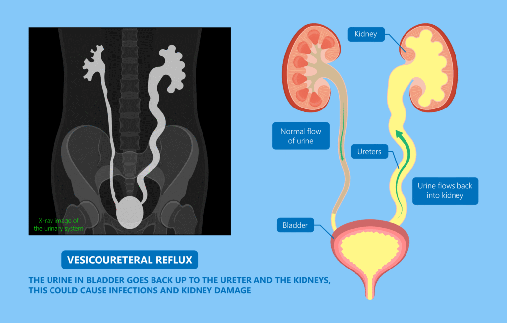 Diagram showing vesicoureteral reflux (VUR), where urine flows backward from the bladder to the kidneys, increasing the risk of infection and kidney damage.