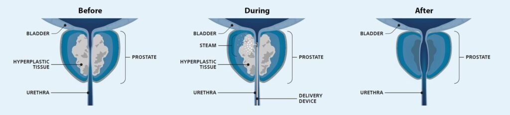 Before, during, and after illustrations of Rezum therapy showing reduced prostate size and improved urine flow