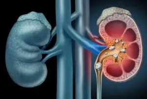 Kidney stone treatment Kuala Lumpur