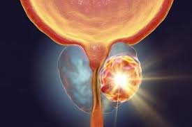 Prostate lump requiring biopsy for prostate cancer diagnosis.