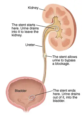 Kidney Stone Treatment in Kuala Lumpur - stent