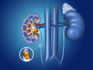 Kidney Stone Treatment in Kuala Lumpur