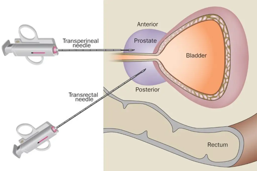 Diagram showing the difference in approach for transrectal and transperitoneal biopsy for prostate cancer diagnosis