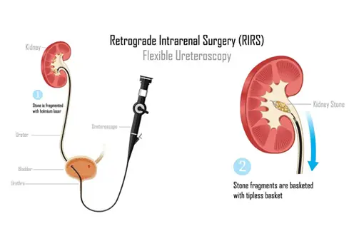 kidney stone treatment in Kuala Lumpur - RIRS