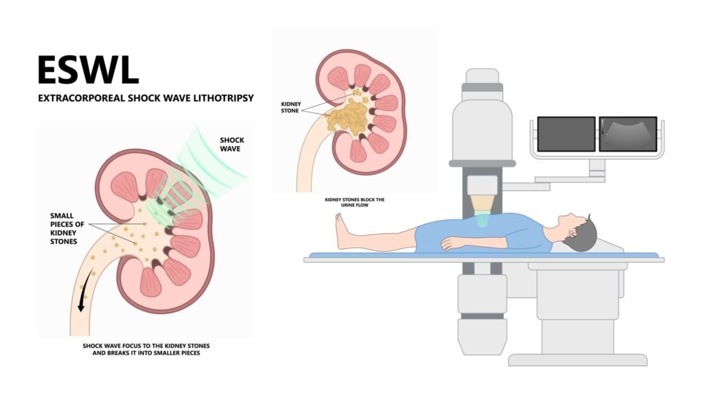 kidney stone treatment in Kuala Lumpur - ESWL