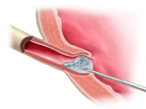 Deflux injection for Vesicoureteral reflux (VUR) in children, available with Dr. Roger, consultant urologist in Prince Court Medical Centre, Kuala Lumpur.