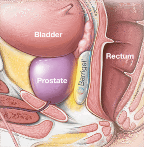 Barrigel rectal spacer for prostate cancer