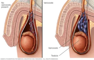 Illustration showing varicocele