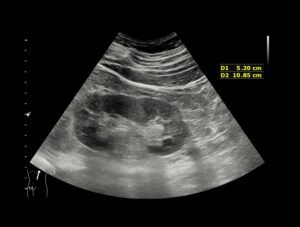 Ultrasound scan being performed to check bladder and kidneys for causes of recurrent UTIs