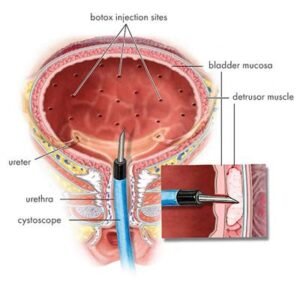 Botox injection into bladder wall for overactive bladder treatment