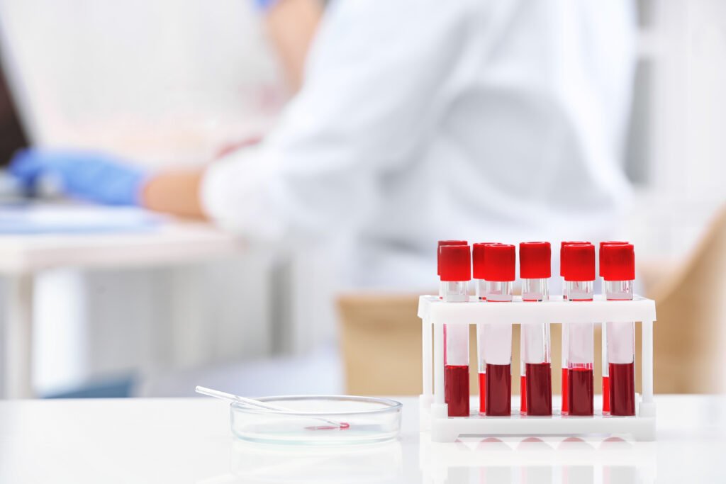 Prostate Health Index (PHI) blood test sample used to assess prostate cancer risk