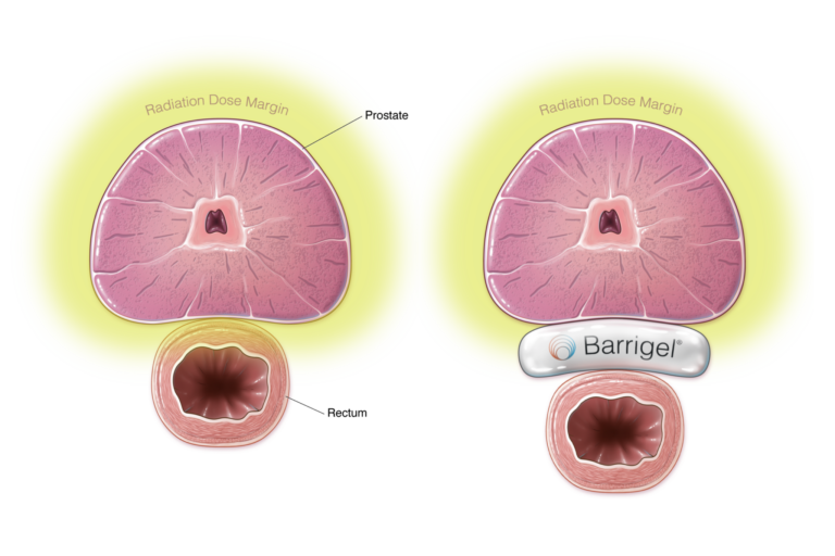 Illustration showing prostate and rectum before and after Barrigel rectal spacer placement during prostate radiotherapy