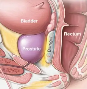 Medical illustration showing Barrigel rectal spacer positioned between the prostate and rectum