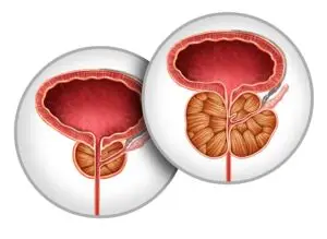 Anatomical illustration showing enlarged prostate tissue in benign prostatic hyperplasia (BPH)