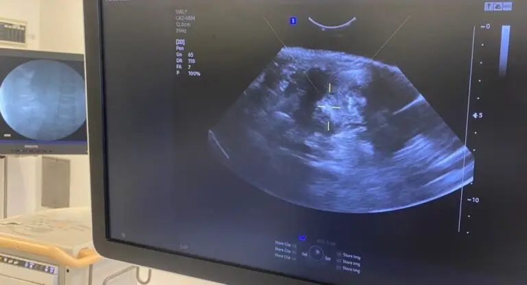 Ultrasound imaging used to locate a kidney stone during ESWL treatment