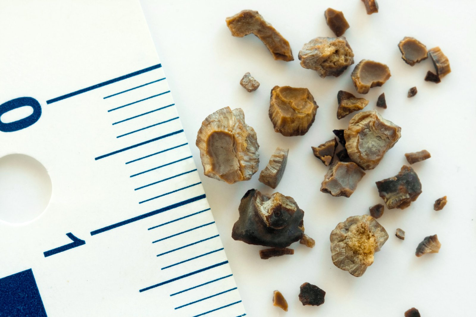 kidney-stone-fragments-urology-treatment-kuala-lumpur.jpg