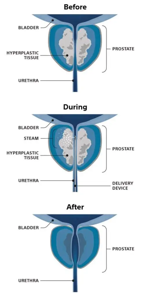Diagram showing how Rezūm™ water vapour therapy treats enlarged prostate tissue before, during, and after treatment