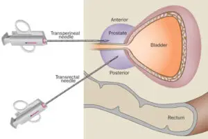 Diagram comparing transperineal and transrectal prostate biopsy routes
