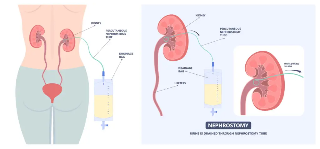 Illustration showing a nephrostomy tube draining urine directly from the kidney into an external collection bag.