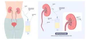 Illustration showing a nephrostomy tube draining urine directly from the kidney into an external collection bag.