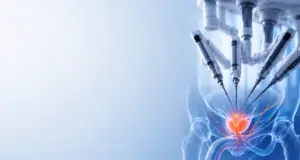 Illustration of robotic-assisted prostate surgery showing surgical instruments targeting the prostate while preserving surrounding nerves.