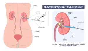 Illustration of percutaneous nephrolithotomy (PCNL) showing direct access into the kidney for treatment of large kidney stones.
