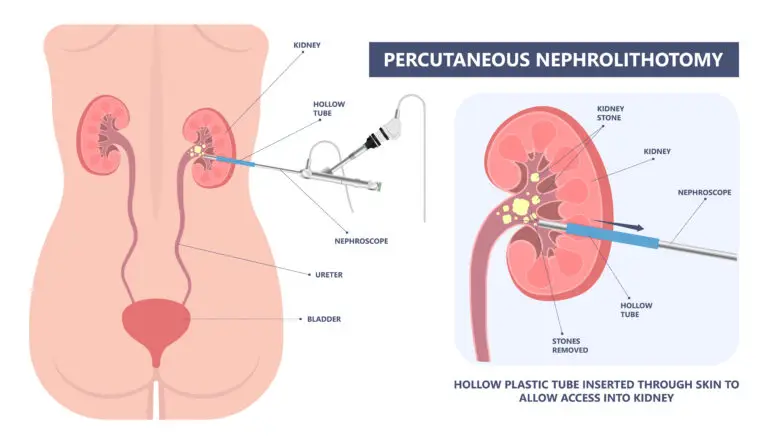 Illustration of percutaneous nephrolithotomy (PCNL) showing direct access into the kidney for treatment of large kidney stones.