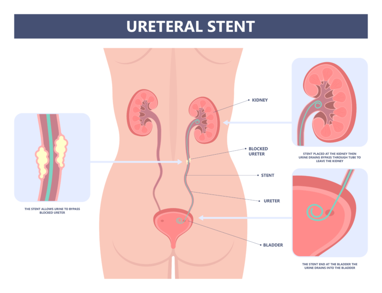Illustration showing a ureteric stent positioned between the kidney and bladder to allow urine to bypass an obstructed ureter.
