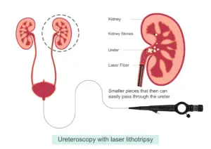 Ureteroscopy with laser lithotripsy for the treatment of kidney stones