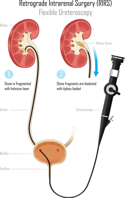 Diagram showing how RIRS (Retrograde Intrarenal Surgery) treats kidney stones using a flexible ureteroscope and laser fragmentation.