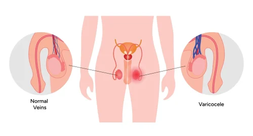 Simplified anatomical illustration showing varicocele with enlarged scrotal veins compared with normal venous drainage.